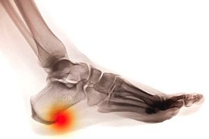 Signs of a Heel Spur