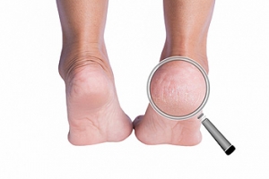 Several Causes for Cracked Heels