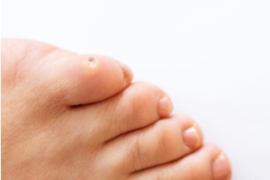 How to Treat and Prevent Foot Corns